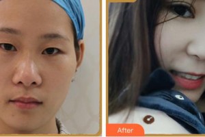 瀘州愛(ài)瑞眼科醫(yī)院胡海燕整形價(jià)格表附眼部綜合案例展示