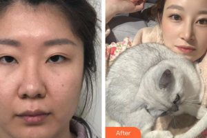 深圳臻瑞芝美醫(yī)療美容門診部林靖整形價格表附眼部修復(fù)案例展示