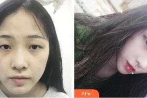 瀘州碧特牙科醫(yī)院王沐釷整形價(jià)格表附雙眼皮案例展示