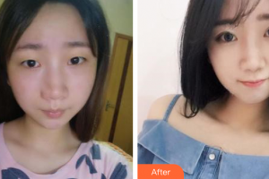 深圳瑞光醫(yī)療美容門診部周曉毛整形價格表附自然雙眼皮案例展示