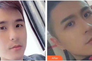 瀘州愛(ài)瑞眼科醫(yī)院張可杰整形價(jià)格表附眼部綜合案例展示