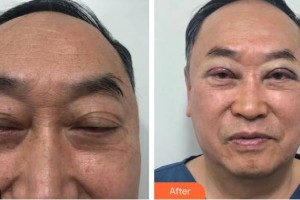 瀘州市婦幼保健院眼科曹世華整形價(jià)格表附眼部綜合案例展示