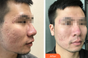 深圳博愛醫(yī)院整形美容中心楊昕整形價格表附清潔祛痘案例展示