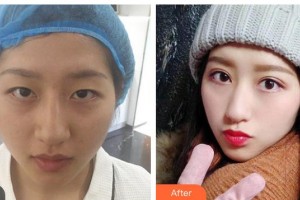 瀘州愛(ài)爾眼科醫(yī)院袁長(zhǎng)明整形價(jià)格表附眼部綜合案例展示