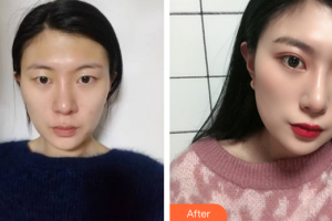 深圳恒生醫(yī)院整形美容中心陳兵整形價格表附眼部手術(shù)案例展示