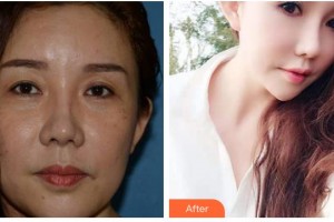 瀘州愛(ài)爾眼科醫(yī)院胡明江整形價(jià)格表附外切祛眼袋案例展示