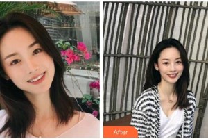 瀘州碧特牙科醫(yī)院雷光揚(yáng)整形價(jià)格表附金屬托槽矯正案例展示