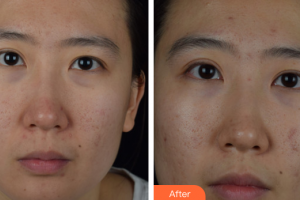 深圳廣濟門診部醫(yī)療美容科周鵬武整形價格表附去痘印痘坑案例展示