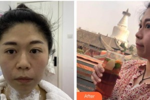 德陽(yáng)德美醫(yī)療美容門診部莊景菊整形價(jià)格表附熱瑪吉案例展示