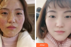 深圳景田醫(yī)院整形美容中心鄧銳整形價格表附綜合祛斑案例展示