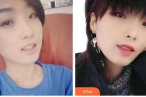 德陽(yáng)德美醫(yī)療美容門診部蔣克鋒整形價(jià)格表附金屬托槽矯正案例展示