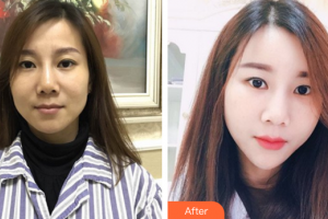 深圳東港醫(yī)療美容門診部艾志剛整形價格表附自體脂肪填充案例展示