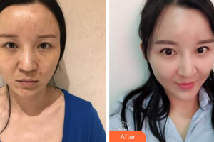 深圳同仁醫(yī)療美容醫(yī)院蘇英整形價格表附自體脂肪面部填充案例展示