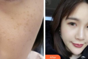 德陽(yáng)德美醫(yī)療美容門診部張涖整形價(jià)格表附激光美膚激光案例展示