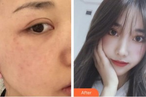 德陽(yáng)市人民醫(yī)院燒傷整形科李云飛整形價(jià)格表附激光美膚激光案例展示