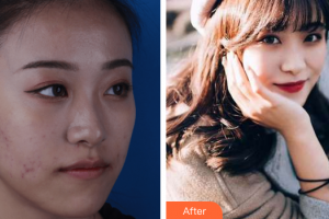 深圳和協(xié)門診部整形美容科何杰整形價格表附清潔祛痘案例展示