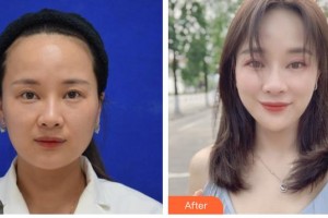 德陽(yáng)市人民醫(yī)院燒傷整形科胡曉東整形價(jià)格表附埋線提升案例展示