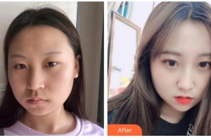 德陽(yáng)市人民醫(yī)院燒傷整形科李永忠整形價(jià)格表附埋線提升案例展示