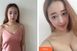 深圳和協(xié)門診部整形美容科李寶武整形價格表附假體豐胸案例展示