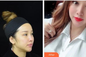 德陽(yáng)市人民醫(yī)院燒傷整形科陸蓉整形價(jià)格表附射頻緊膚案例展示