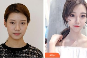 德陽(yáng)市人民醫(yī)院燒傷整形科陳莉整形價(jià)格表附埋線提升案例展示