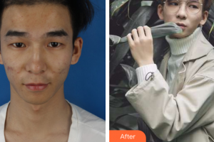 深圳和協(xié)門診部整形美容科安超整形價格表附祛痘煥膚案例展示