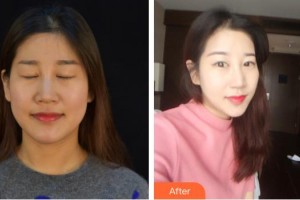 德陽(yáng)金榮醫(yī)療美容?？漆t(yī)院沈軍國(guó)整形價(jià)格表附熱瑪吉案例展示