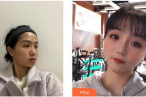 德陽(yáng)金榮醫(yī)療美容?？漆t(yī)院吳沙冰整形價(jià)格表附埋線提升案例展示