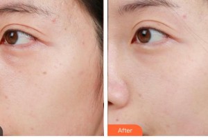 德陽(yáng)金榮醫(yī)療美容專科醫(yī)院尹靜整形價(jià)格表附激光美膚激光案例展示