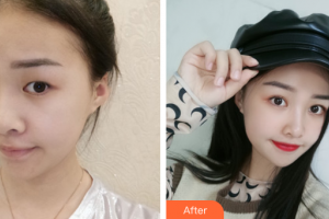 深圳和協(xié)門診部整形美容科牟北平整形價格表附眼部整形案例展示