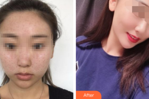 深圳和協(xié)門診部整形美容科劉開山整形價(jià)格表附去痘印痘坑案例展示