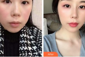 德陽金榮醫(yī)療美容?？漆t(yī)院邊森整形價格表附鼻部綜合案例展示