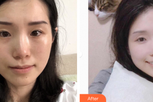 深圳鵬愛秀琪醫(yī)療美容醫(yī)院劉亞慧整形價(jià)格表附白瓷娃娃案例展示