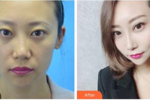 德陽德美醫(yī)療美容門診部張莉整形價格表附埋線提升案例展示