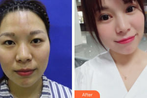 深圳鵬愛秀琪醫(yī)療美容醫(yī)院薛林兵整形價(jià)格表附全切雙眼皮案例展示