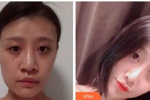 德陽德美醫(yī)療美容門診部王亞國整形價格表附鼻部綜合案例展示