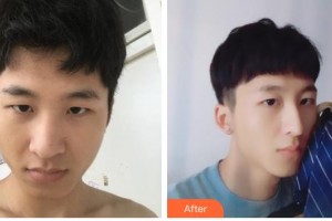 德陽東美醫(yī)療美容整形門診部鐘正強整形價格表附鼻部綜合案例展示