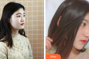 深圳艾妍醫(yī)療美容門診部楊曉楠整形價格表附鼻部手術(shù)案例展示