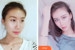 深圳瑞芙臣醫(yī)療美容門診部陳美珠整形價格表附鼻部整形案例展示