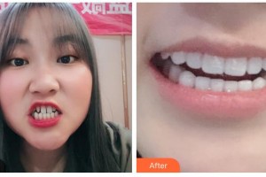 德陽維樂新橋口腔門診部劉詩奇整形價格表附冷光美白案例展示