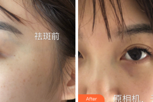 深圳臻瑞芝美醫(yī)療美容門診部張秀麗整形價格表附祛斑案例展示