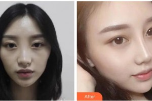 綿陽煌佳醫(yī)學美容診所曹喜蓉整形價格表附鼻部綜合案例展示