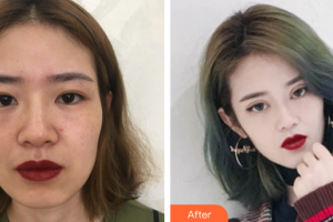 深圳臻瑞芝美醫(yī)療美容門診部周偉整形價(jià)格表附切開雙眼皮+倒睫矯正案例展示