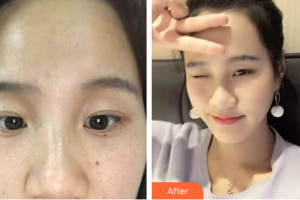 深圳新興皮膚病?？崎T診部方梅君整形價(jià)格表附祛雀斑案例展示