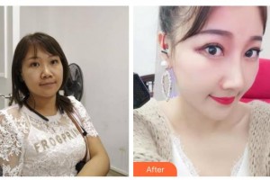 綿陽煌佳醫(yī)學美容診所李忠永整形價格表附鼻中隔軟骨隆鼻案例展示