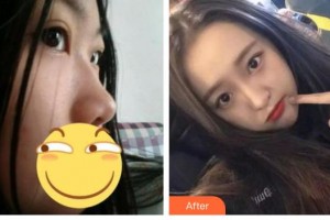 綿陽協(xié)和醫(yī)院醫(yī)學美容中心孟春麗整形價格表附肋軟骨隆鼻案例展示