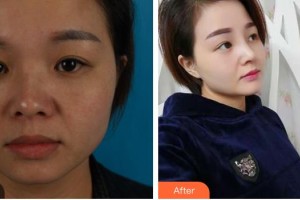 綿陽整形美容醫(yī)院趙波整形價格表附耳軟骨復合隆鼻案例展示