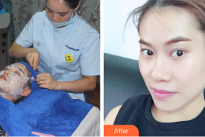 深圳美雅童顏醫(yī)療美容醫(yī)院張海晏整形價(jià)格表附黃金微針案例展示