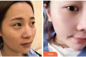 綿陽中心醫(yī)院醫(yī)學美容科周竹梅整形價格表附鼻部綜合案例展示