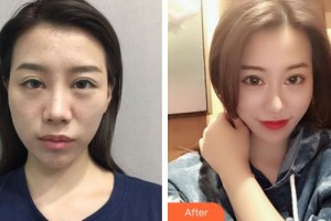 綿陽中心醫(yī)院醫(yī)學美容科周平武整形價格表附鼻部綜合案例展示